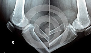 plain x ray on knee joint showing joint space narrowing and Subchondral Sclerosis on medial compartment photo