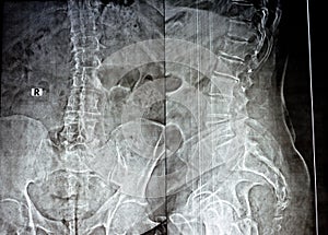 Plain x ray of the lumber spine in AP and lateral views, marginal anterior osteophytic lipping of the vertebral end plates, photo