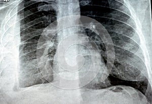 Plain X ray for a patient with aspiration pneumonia right lung, empyema, pleural effusion after insertion of a chest thoracostomy photo