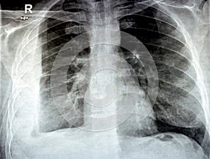 Plain X ray for a patient with aspiration pneumonia right lung, empyema, pleural effusion after insertion of a chest thoracostomy photo