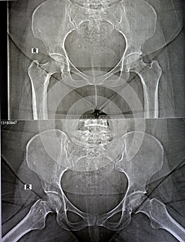 bilateral Avascular necrosis (AVN) of the femoral head more in the left side, a type of aseptic osteonecrosis photo