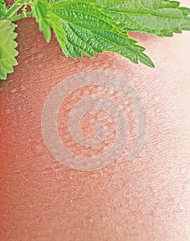 Plant stinging nettle lying on irritated human skin covered with small wrinkles ,cracks and causes a burn with blisters