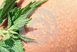 Plant stinging nettle lying on irritated human skin covered with small wrinkles ,cracks and causes a burn with blisters