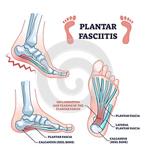 Plantar fasciitis as fascia muscle inflammation and tearing outline diagram