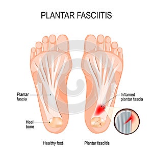 Plantar fasciitis. disorder of the connective tissue which supports the arch of the foot