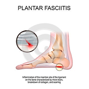 Plantar fasciitis. foot anatomy