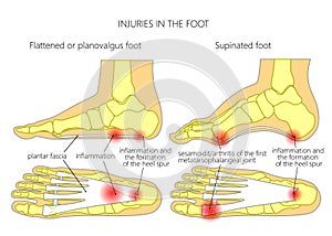 Plantar fasciitis_heel spur_sesamoidit