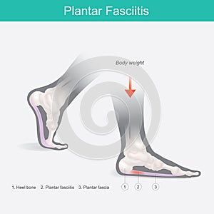 Plantar Fasciitis. Illustration human foot.