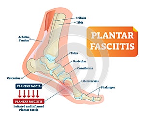 Plantar fasciitis vector illustration. Labeled human feet disorder diagram.