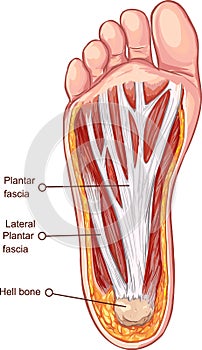 Plantar fascitis illustration