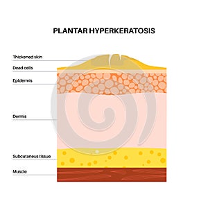 Plantar hyperhidrosis poster