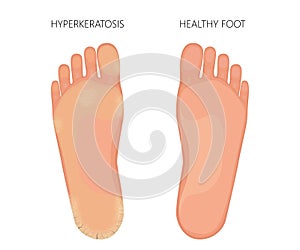 Plantar Hyperkeratosis