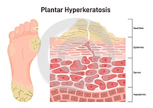 Plantar hyperkeratosis. Feet corns and calluses, medical condition