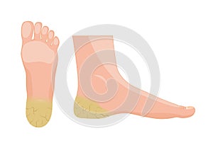 Plantar Hyperkeratosis vector / human anatomy