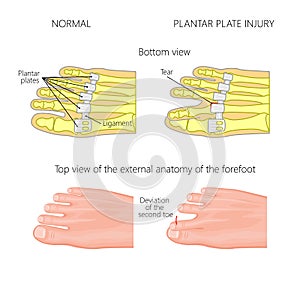 Plantar plate tear. Deviation of the toe