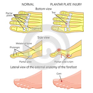 Plantar plate tear. Hammer toe