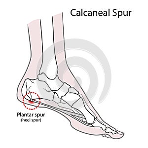 Plantar spur calcaneal spur. Human foot bones. Illustration Isolated on a white background photo