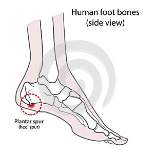 Plantar spur calcaneal spur. Human foot bones. illustration Isolated on a white background