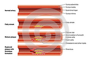 Plaque formation in artery