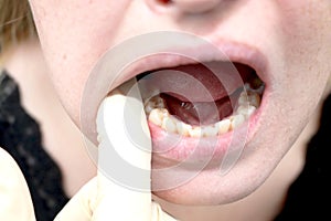 Plaque of the patient, stone. Dentistry treatment of dental plaque, professional oral hygiene, The concept of harm to smoking and