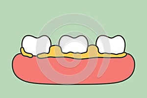 Plaque or tartar, cause of tooth periodontal disease