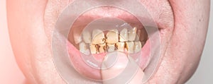 Plaque teeth cavities and paradontosis in the man`s mouth. Dental decay problems and bad smile. Dentist treatment, health care