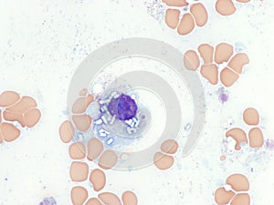 Plasma cell with crystalline inclusions in the cytoplasm.
