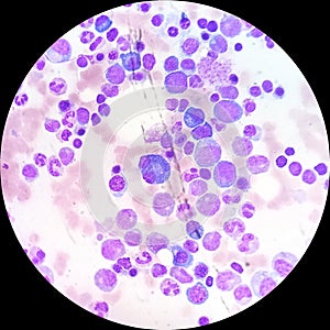 Plasma cells in multiple myeloma
