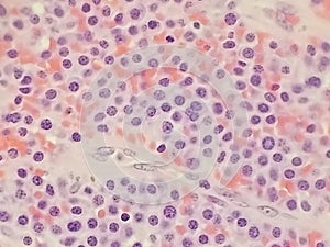 Plasmablastic anaplastic Multiple Myeloma - Plasmacytoma Biopsy Specimen photo