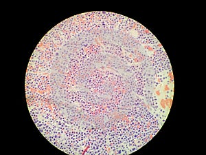 Plasmablastic anaplastic Multiple Myeloma - Plasmacytoma Biopsy Specimen photo