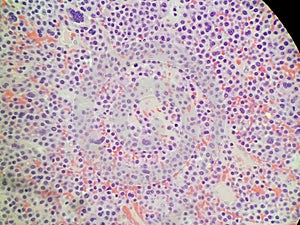 Plasmablastic anaplastic Multiple Myeloma - Plasmacytoma Biopsy Specimen photo