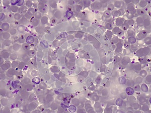 Blood smear of a patient with malaria. Plasmodium falciparum photo