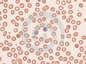 Plasmodium malariae schizontes in peripheral blood.