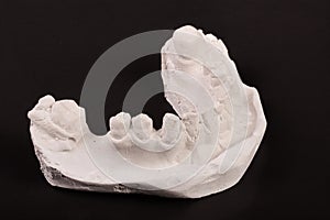 Plaster cast of teeth with removable partial denture on a dark background