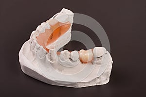 Plaster cast of teeth with removable partial denture on a dark background