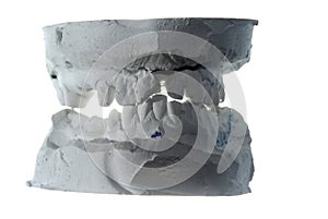 Plaster teeth cast
