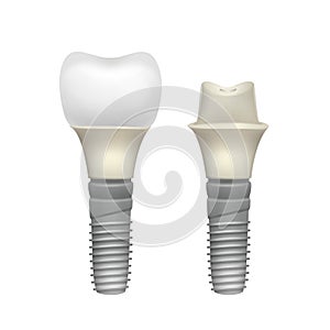 Plastic assembled tooth implant