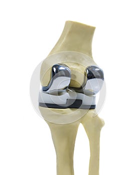 Plastic model of a knee replacement