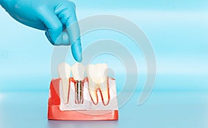 Plastic samples of dental implants compare with natural teeth