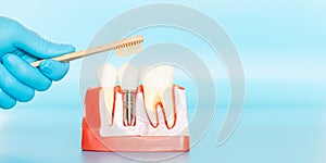 Plastic samples of dental implants compare with natural teeth