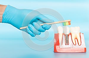 Plastic samples of dental implants compare with natural teeth