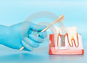 Plastic samples of dental implants compare with natural teeth