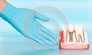 Plastic samples of dental implants compare with natural teeth