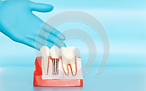 Plastic samples of dental implants compare with natural teeth