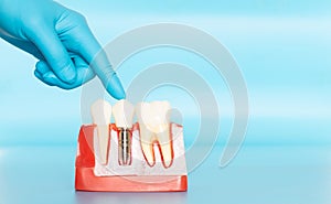 Plastic samples of dental implants compare with natural teeth