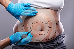 Plastic Surgeon Drawing On Woman`s Body For Surgery