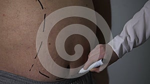 Plastic surgeon marking incision lines on big belly of overweight male, obesity