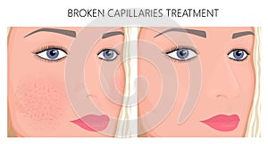Plastic surgery_Broken Capillaries Treatment