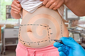 Plastic surgery doctor draw lines with marker on patient belly