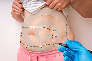 Plastic surgery doctor draw lines with marker on patient belly